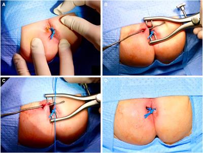 Treatment of pediatric fistula-in-ano—Sphincter-sparing non-cutting seton placement as the future treatment of choice?